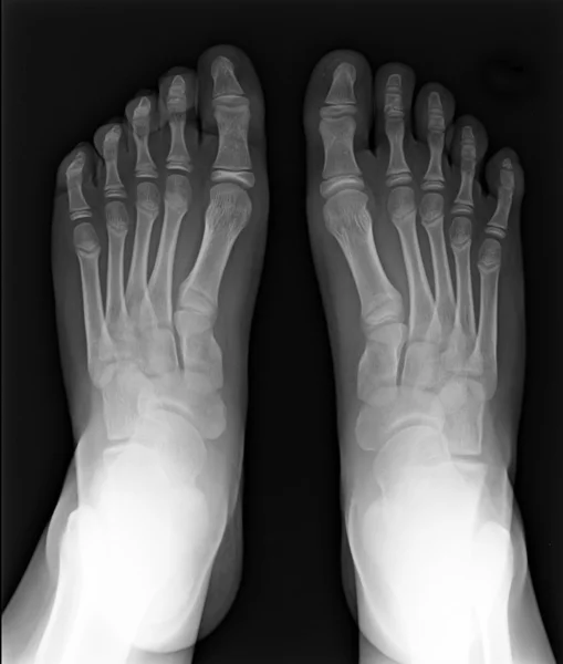 Foot fingers exposed on x-ray black and white film, MRI — Stock Photo, Image