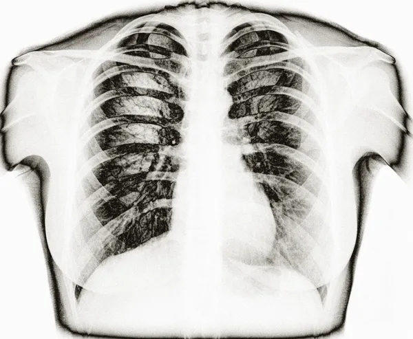 Imagen de rayos X del pecho humano sano — Foto de Stock