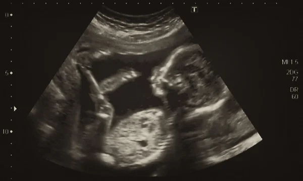 Ultrasonography Analysis of a 4th Month Fetus — Stock Photo, Image