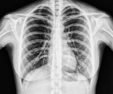 İnsan Sağlıklı Göğsünün X-Ray görüntüsü