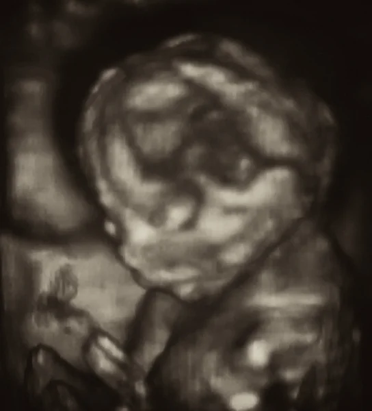 3d 的第 4 个月胎儿的超声检查分析 — 图库照片