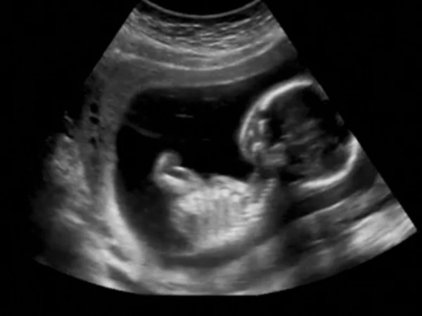Porodní ultrasonografie ultrazvuk echografie prvního měsíce — Stock fotografie