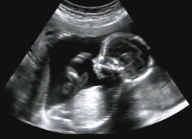 Obstetric Ultrasonography Ultrasound Echography of a first month clipart