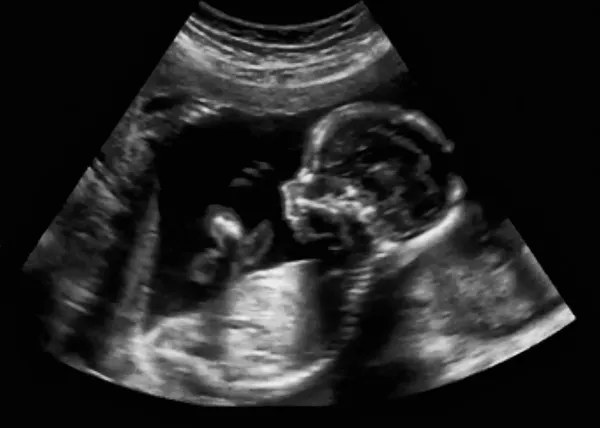 Porodní ultrasonografie ultrazvuk echografie prvního měsíce — Stock fotografie