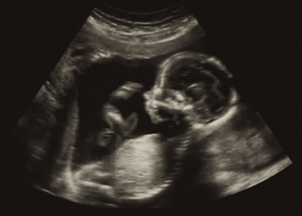 Obstetric Ultrasonography Ultrasound Echography of a first month