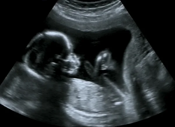 Dördüncü ayda cenin, obstetrik ultrason. Echography tarama