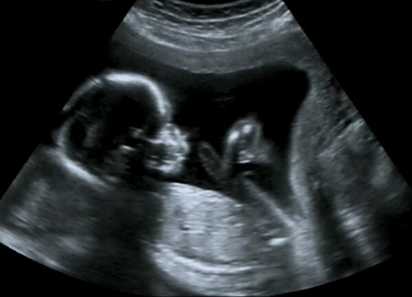 Obstetric Ultrasound of fetus at fourth month. Echography Scan