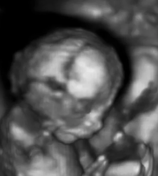 Three Dimensional Ultrasonography of Fetus. 3D Echography — Stock Photo, Image