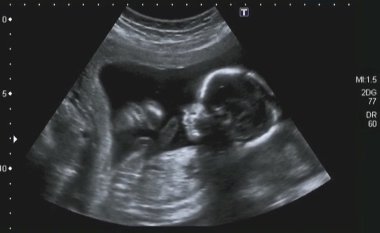 4 ay fetus Ultrasonografi analizleri