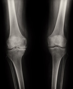 Orthostasis MRG: bir dik ayakta duruş bakımından