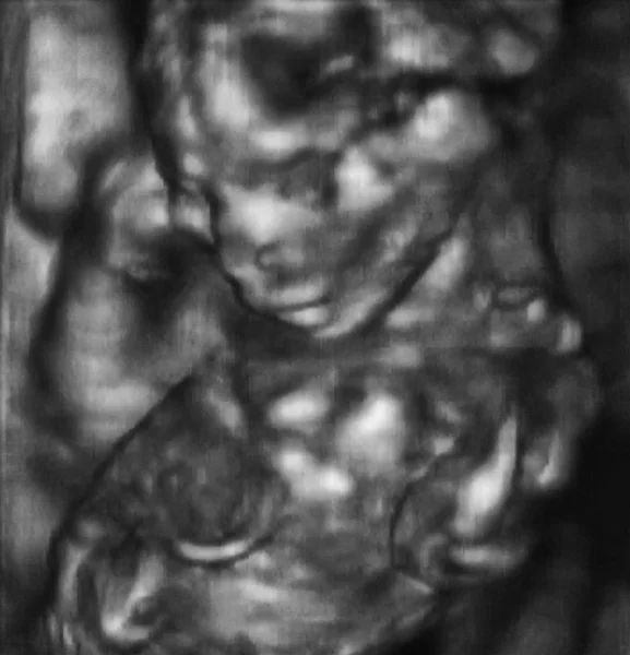 Análise ultrassonográfica 3D de um feto de quarto mês — Fotografia de Stock