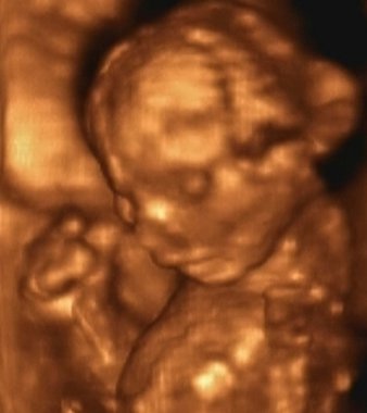 Ultrason echography, 4 ay cenin, İtalya