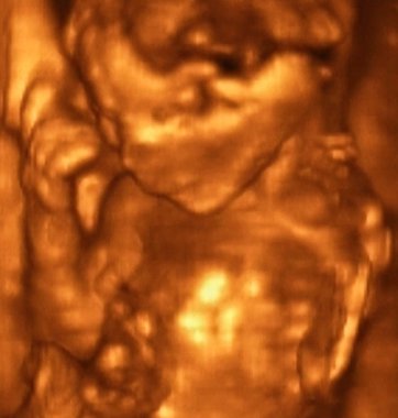 4 ayda cenin 3D Ultrasonografi analizleri