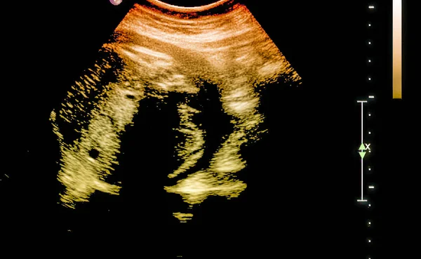 Ultrasound of fetus in third month pregnancy.