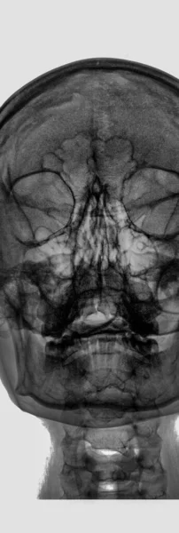 Röntgenbild Des Menschlichen Gehirns Von Vorne — Stockfoto