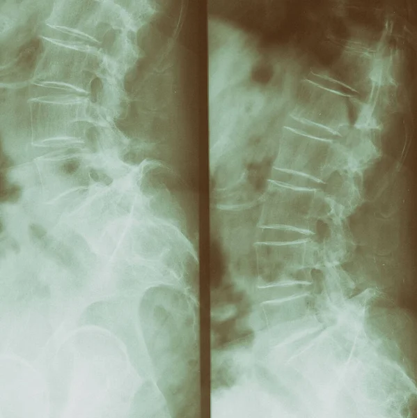 Spine Pelvis Human Body Ray Two Different Split Views — Stock Photo, Image