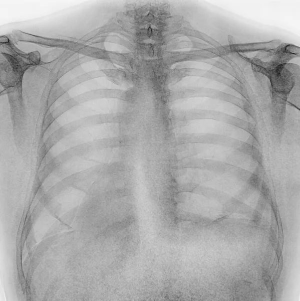 Diagnostický Rentgenový Snímek Hrudníku Pacienta — Stock fotografie