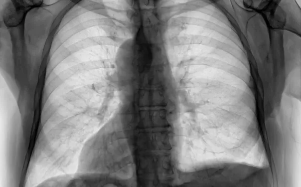 Imagen Rayos Del Tórax Humano Detección Tuberculosis —  Fotos de Stock