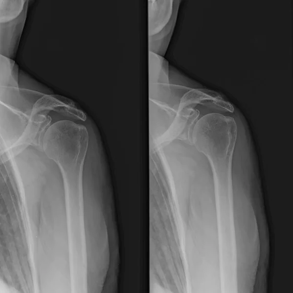 Diagnostischer Röntgenfilm Von Schulter Und Arm Eines Patienten — Stockfoto