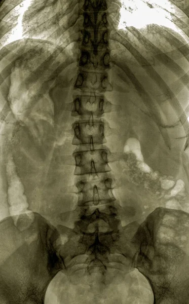 Radiografía Columna Lumbo Sacra Pelvis Exploración Del Examen —  Fotos de Stock