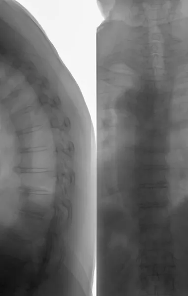 X光下人体的脊柱和骨盆 两种不同的观点 — 图库照片