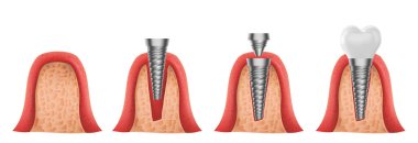 Diş ve diş implantı diş hekiminin gerçekçi vektör tasarımı