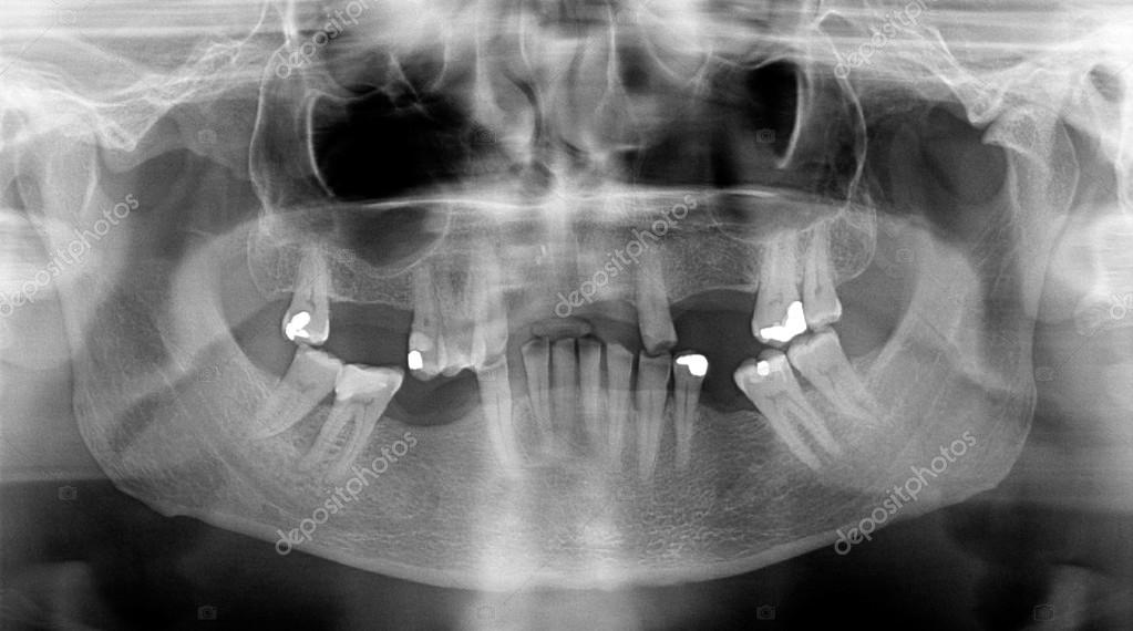 Panoramic dental XRays Stock Photo by ©ribeiroantonio 16979057