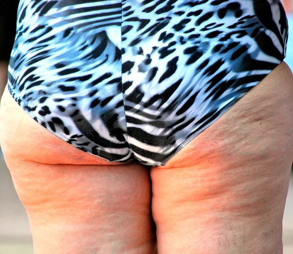 Cellulite. — Stockfoto