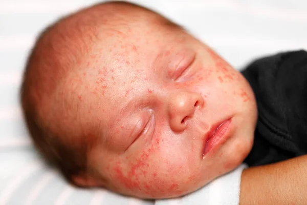 Closeup of baby face skin with pimples and acne from dermatitis. Concept of newborn baby hygiene, health and skin care.