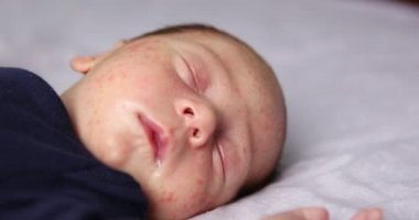 Deri iltihabı yüzünden sivilceli bebek yüz derisi. Yeni doğan bebek hijyeni, sağlık ve cilt bakımı kavramı.