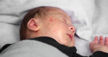 Deri iltihabı yüzünden sivilceli bebek yüz derisi. Yeni doğan bebek hijyeni, sağlık ve cilt bakımı kavramı.
