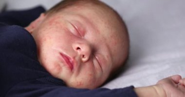 Deri iltihabı yüzünden sivilceli bebek yüz derisi. Yeni doğan bebek hijyeni, sağlık ve cilt bakımı kavramı.