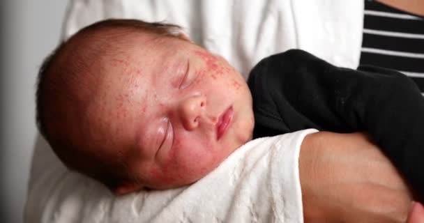 Closeup Baby Face Skin Pimples Acne Dermatitis Concept Newborn Baby — Stock Video