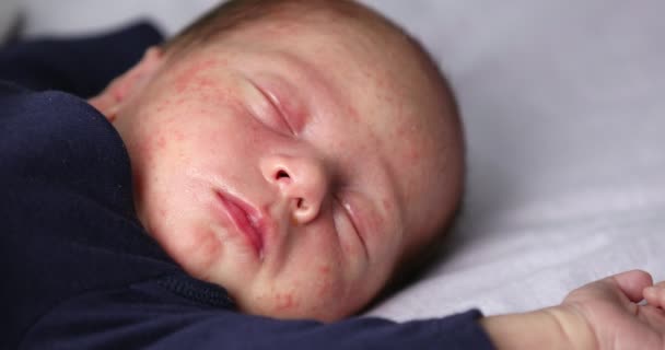 Close Van Baby Gezichtshuid Met Puistjes Acne Van Dermatitis Concept — Stockvideo