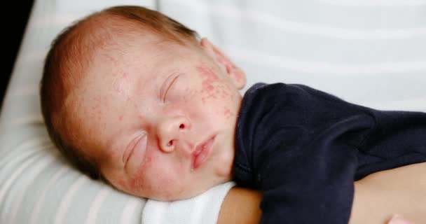 Close Van Baby Gezichtshuid Met Puistjes Acne Van Dermatitis Concept — Stockvideo