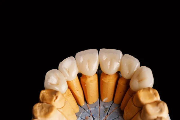 Denti Ceramica Bianca Isolati Sfondo Nero — Foto Stock