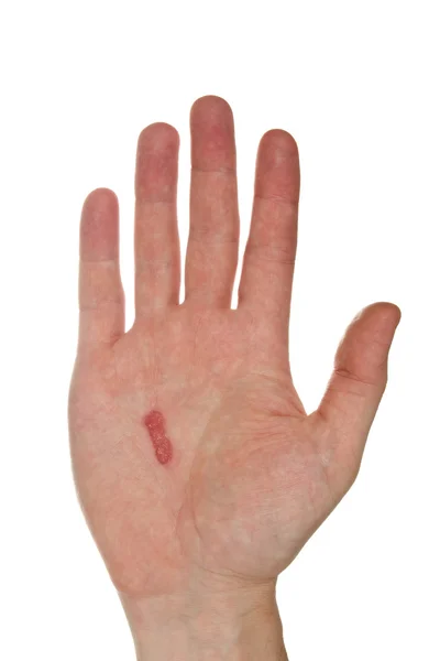 남성 손에 굳은 살 — 스톡 사진
