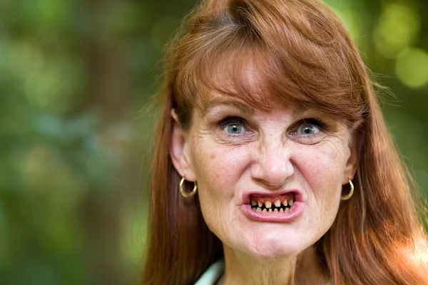 Cancer Treatment Teeth — Stock Photo, Image