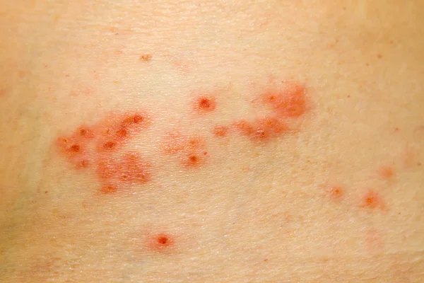 Shingles Rash — Stock Photo, Image