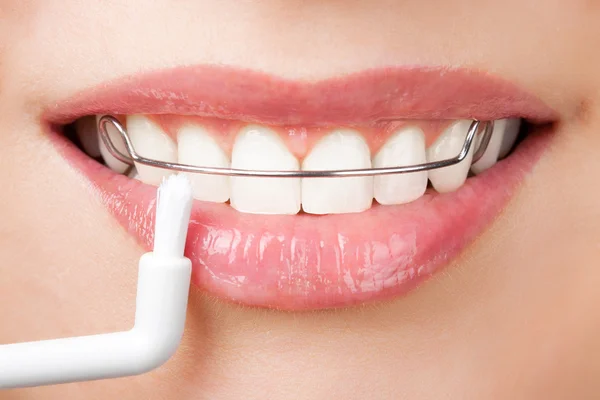 Чистка зубов с помощью фиксатора — стоковое фото