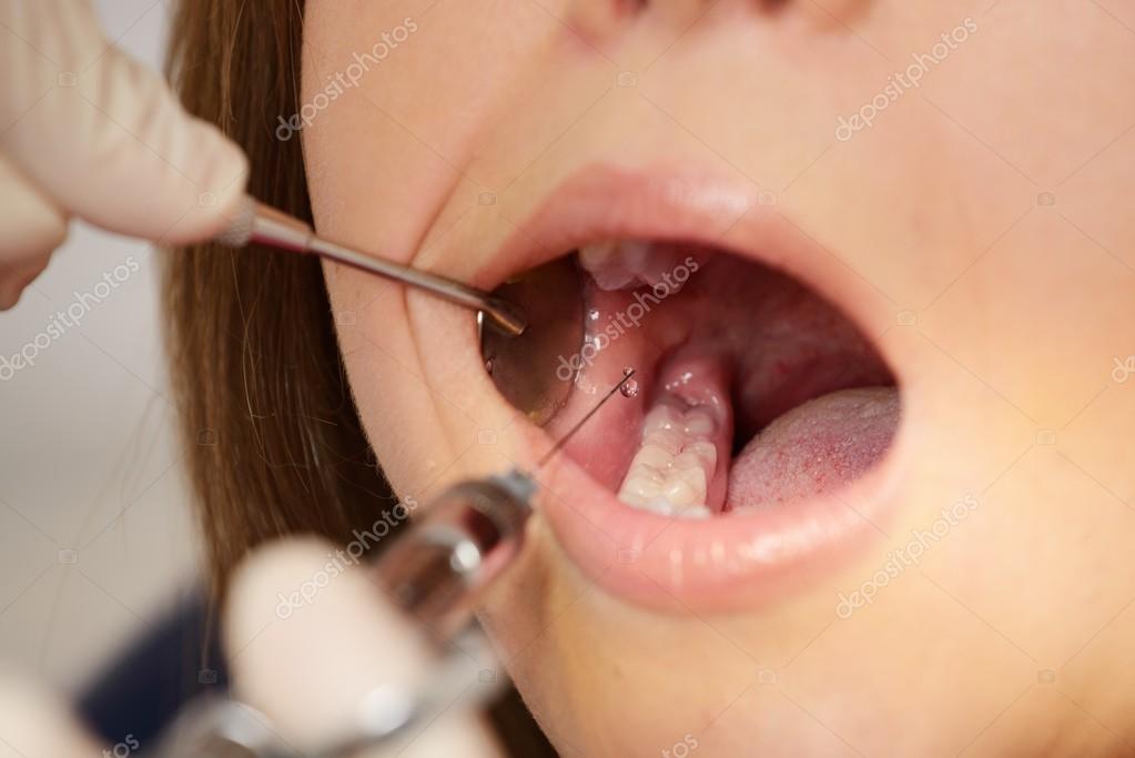 Dentist making anaesthetic injection to woman patient Stock Photo by