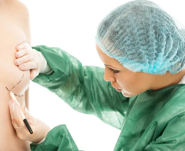 Plastic surgeon woman drawing on body lines for breast implant operation — Stock Photo, Image