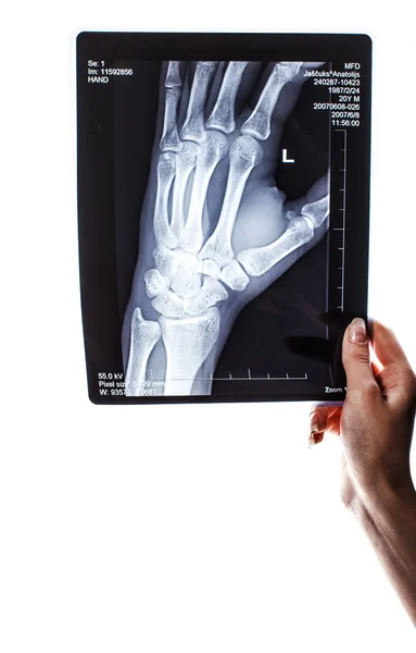 X-ray image of arm — Stock Photo, Image