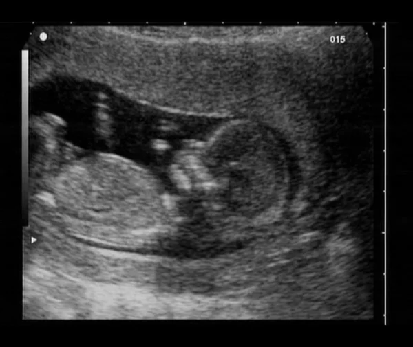 Ultrasound fetus — Stock Photo, Image