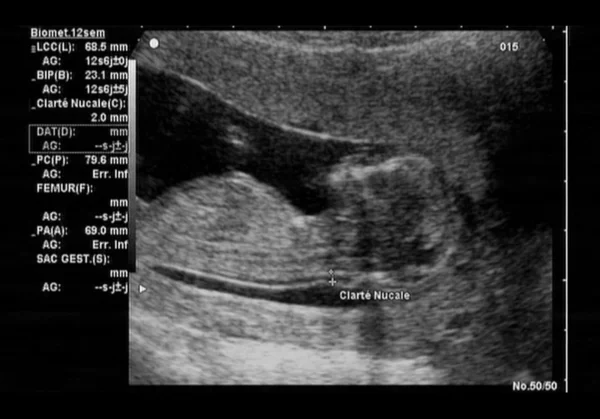 Ultrasonido fetal —  Fotos de Stock