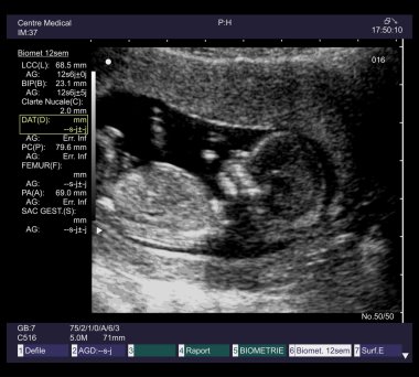 ultrasound fetus clipart