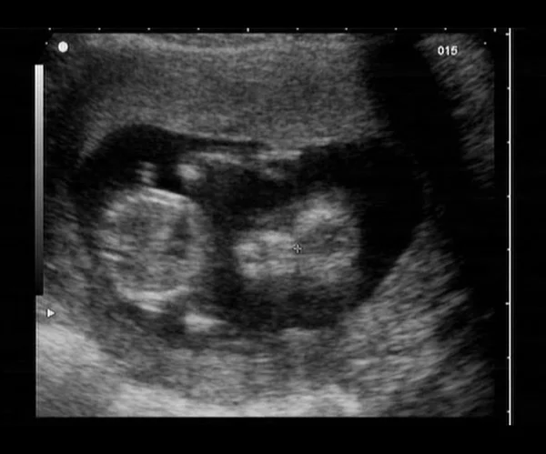 Ultrasonido fetal — Foto de Stock