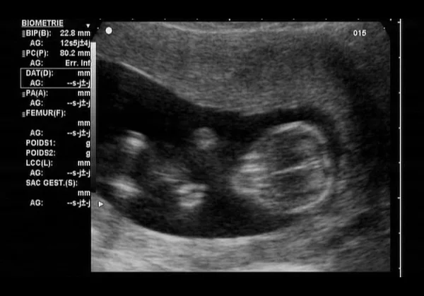 Υπερηχογράφημα έμβρυο — Φωτογραφία Αρχείου