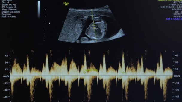 Ultraljud av gravid kvinna — Stockvideo