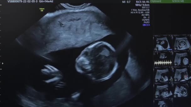 Ultrazvuk těhotné ženy — Stock video